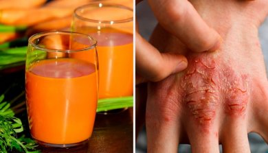 7 remèdes naturels pour combattre le psoriasis