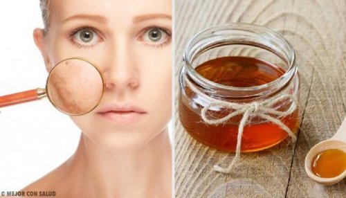5 remèdes maison pour traiter les infections cutanées
