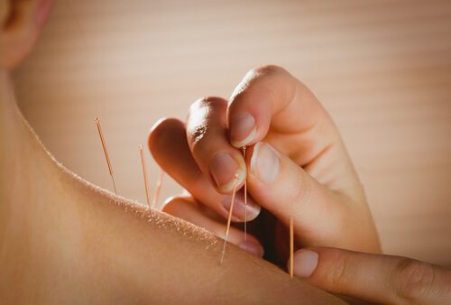 Acupuncture : ses bienfaits sur la santé