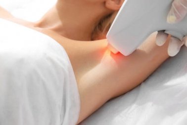 Mythes et vérités sur l'épilation au laser
