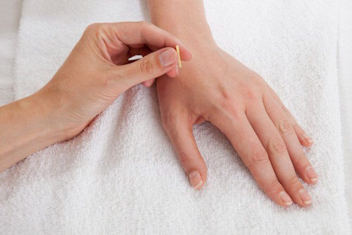 fonctionnement de l'acupuncture