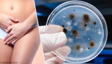 Infections vaginales : types et causes