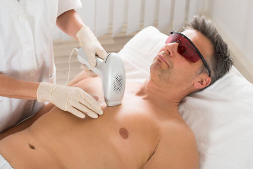 tout savoir de l'épilation au laser