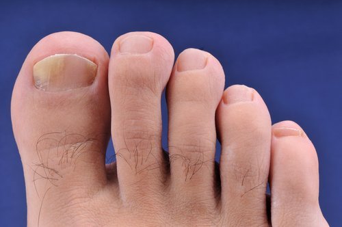 Les tongs de plage provoquent des mycoses.