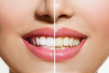 Des produits naturels qui vous aideront à blanchir vos dents
