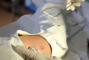 Pouvez-vous tomber enceinte avec un implant de progestérone ?