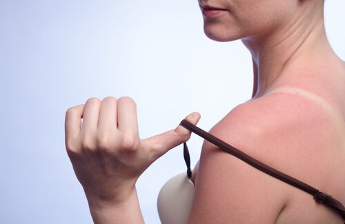7 remèdes naturels pour soigner les coups de soleil
