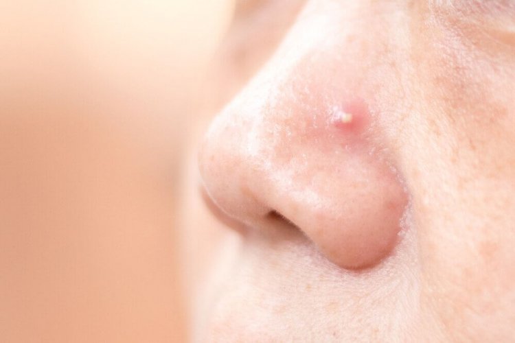 Comment traiter les boutons sur le nez avec 4 remèdes maison