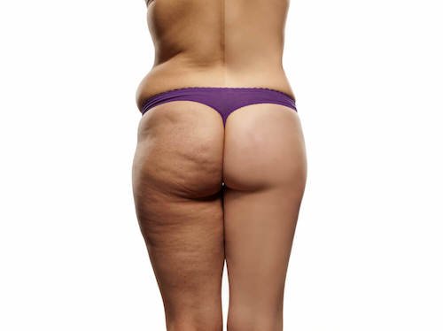 Comment faire un régime pour réduire la cellulite