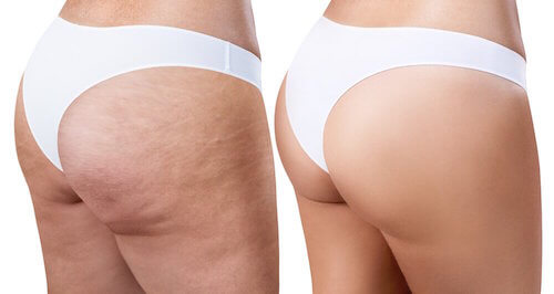 Le romarin pour soigner la cellulite.
