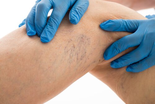 lutter contre les varices