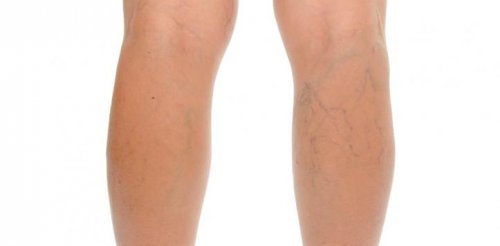 Varices au niveau des jambes