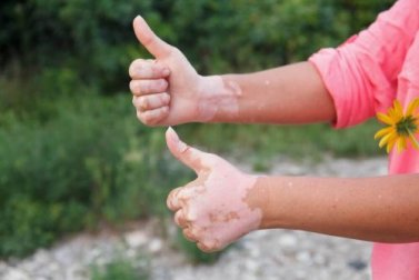 Maladies auto-immunes : aliments autorisés et interdits