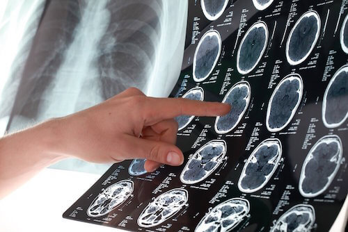 6 conseils pour prévenir un AVC