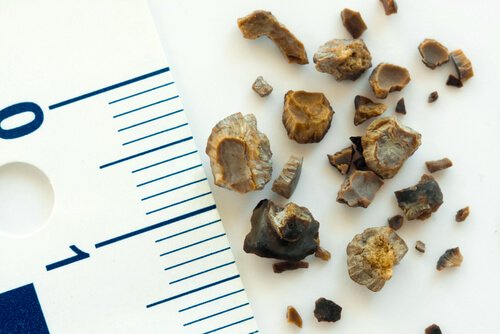 les causes des calculs rénaux