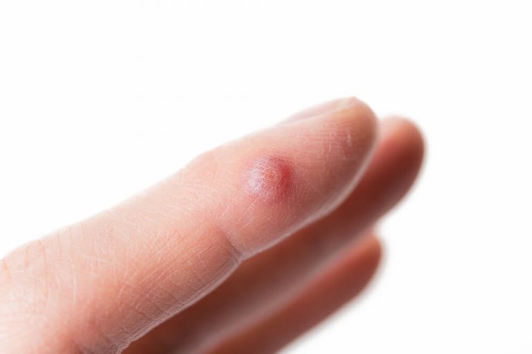 5 solutions naturelles pour éliminer les verrues sur vos doigts