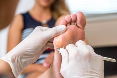 Les meilleures alternatives pour éliminer les callosités gênantes sur les pieds
