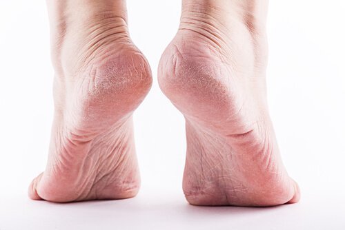 les callosités des pieds