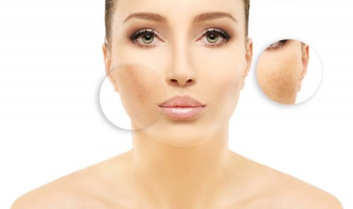 Comment réduire l'hyperpigmentation avec 5 remèdes maison