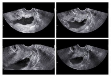 L'insuffisance cervicale : qu'est-ce que c'est et comment savoir si nous en souffrons ?