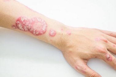 Combattre le psoriasis avec ces remèdes d'origine naturelle