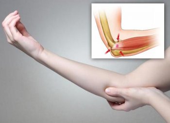 5 remèdes naturels pour soulager un tennis elbow