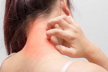3 remèdes naturels pour soulager les allergies cutanées