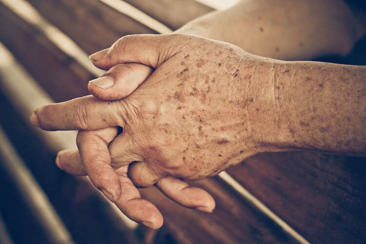 Les 5 meilleurs remèdes contre les taches hépatiques Les 5 meilleurs remèdes contre les taches hépatiques