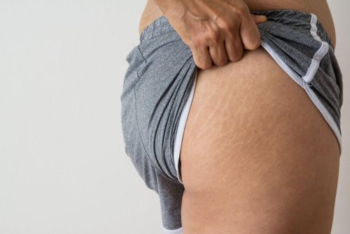 5 traitements à l’huile de noix de coco pour réduire les vergetures et les cicatrices 5 traitements à l’huile de noix de coco pour réduire les vergetures et les cicatrices
