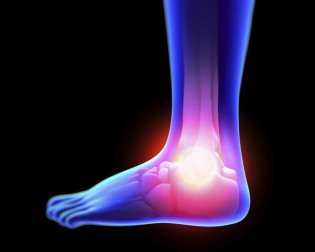 Entorses : comment traiter les symptômes de manière naturelle ?