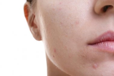 Découvrez cet incroyable traitement pour lutter contre la peau grasse