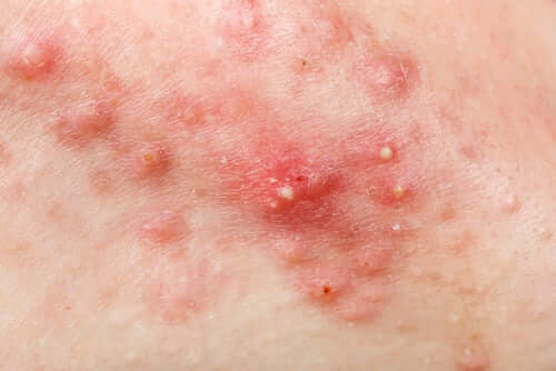 boutons sur les fesses