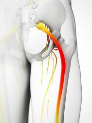 5 compresses pour soulager la sciatique