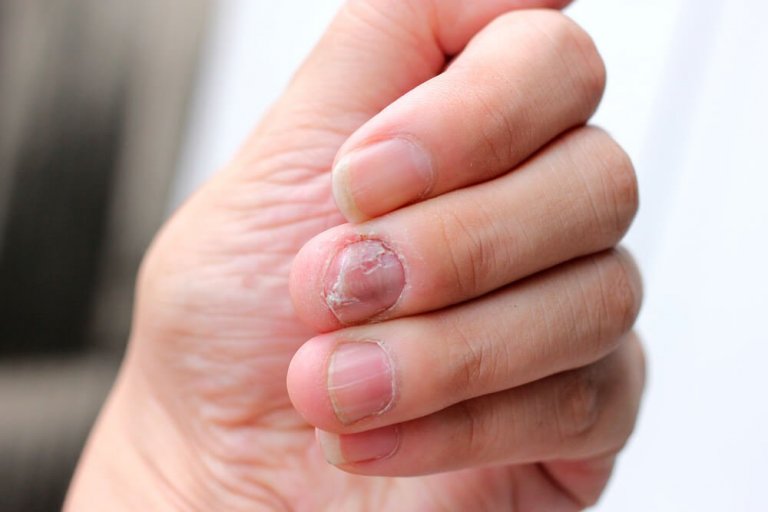 5 remèdes naturels pour lutter contre le psoriasis des ongles
