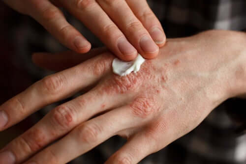 Une main souffrant de psoriasis