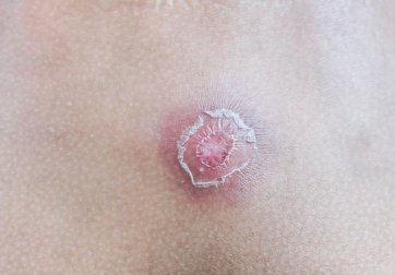 7 conseils pour éliminer les furoncles