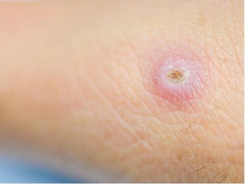 7 conseils pour éliminer les furoncles - Améliore ta Santé