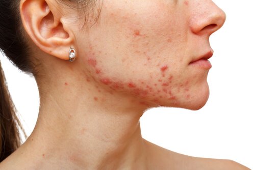 Ce que l'acné peut révéler sur votre santé