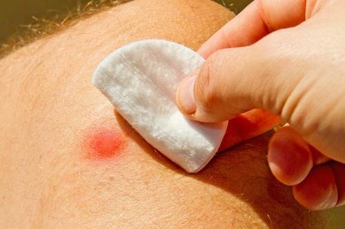 comment soigner les furoncles ?