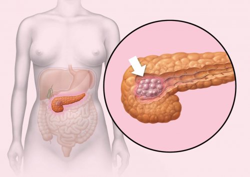 Développement du cancer du pancréas.