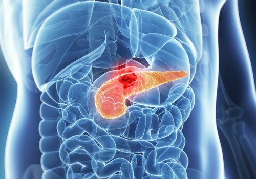 cancer du pancréas