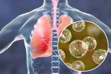 5 remèdes naturels efficaces pour contrer les symptômes de la blastomycose