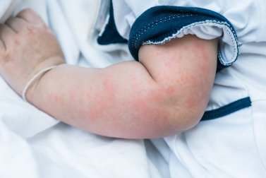 Éruptions cutanées chez les bébés : comment les traiter ?