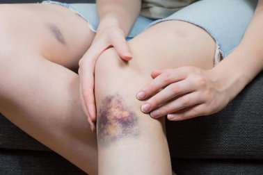 5 solutions naturelles pour atténuer un hématome