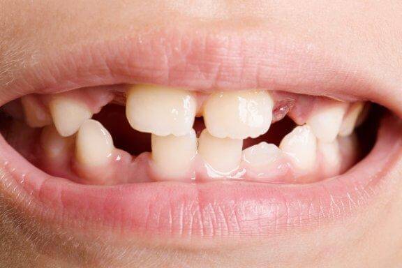 Agénésie dentaire : les différents types et les traitements