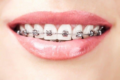 appareil dentaire et agénésie dentaire