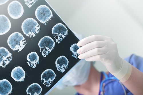 l'influence d'Alzheimer sur le cerveau