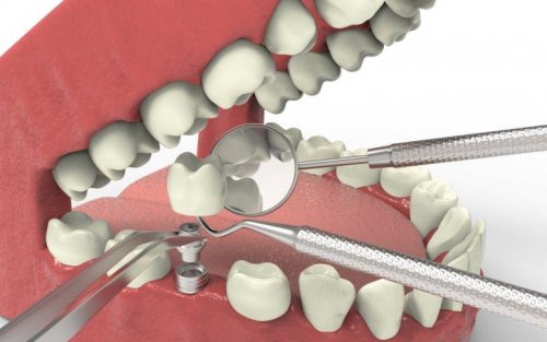 implant en cas d'agénésie dentaire