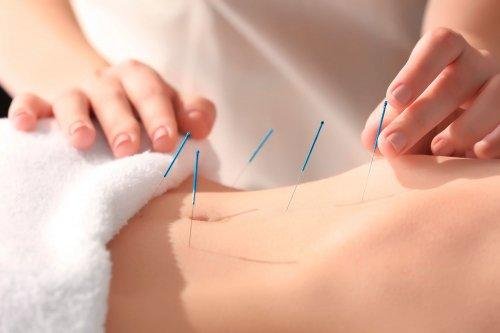 bienfaits de l'acupuncture