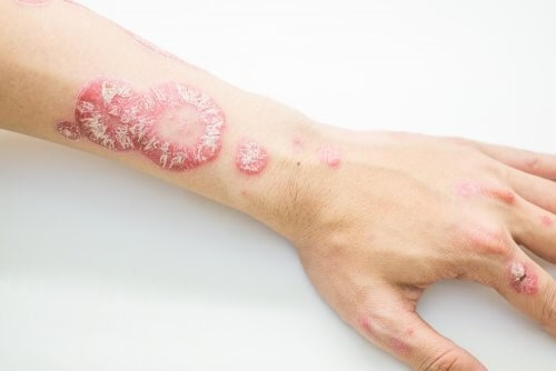 soigner naturellement le psoriasis